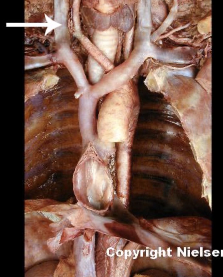 <p>The indicated vessel is the _. The indicated vessel drain the. _, meninges, cranial bones, and muscles and tissues of the face and neck</p>