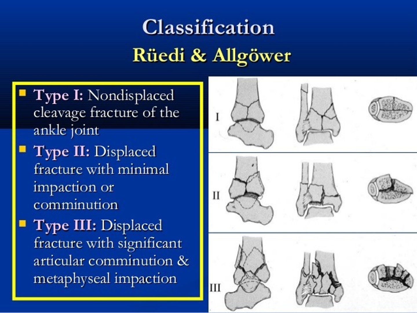 <p>RUEDI & ALLGOWER - Pilon fractures - distal tibial metaphyseal fracture.</p><p>Type 1 - non-displaced tibial fragments</p><p>Type 2 - intra-articular tibial fracture without comminution</p><p>Type 3 - comminution and disruption of tibial articular surface</p>