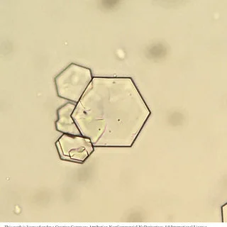 <p>Abnormal (acidic urine).</p><p>Colorless, hexagonal plate, often layered.</p><p>Cystinuria</p>