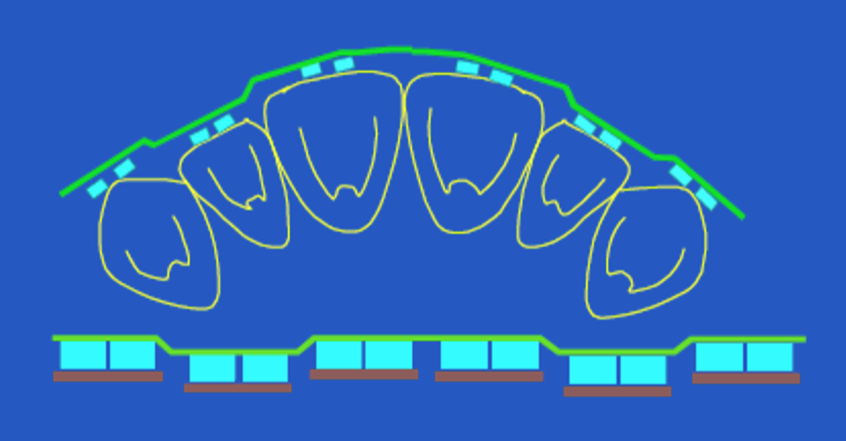 <p>1st order bends</p>