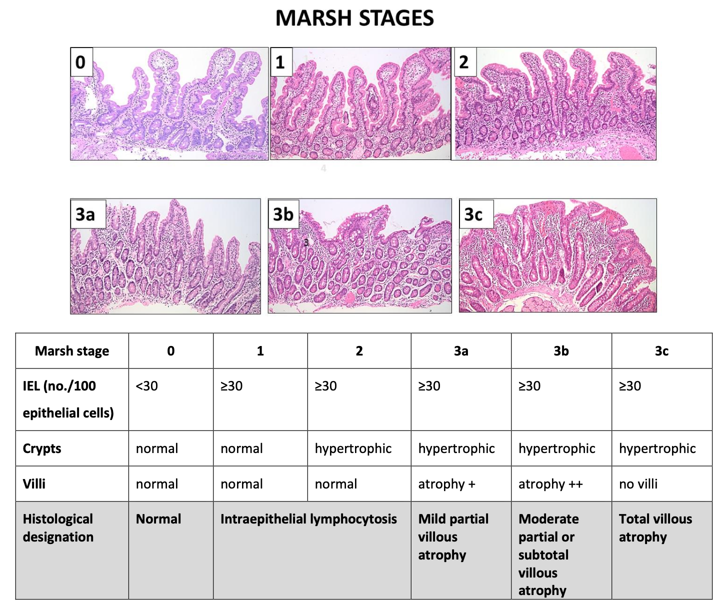 <p>1) </p><ul><li><p>Lymphcytose intraépithéliale >25 IELs/ 100 entérocytes</p></li><li><p>Hyperplasie des cryptes : ratio villosités/cryptes <3/1</p></li><li><p>atrophie villositaire</p></li></ul><p>2) </p><ul><li><p>1) lymphocytose intra-épithéliale</p></li><li><p>2) 1+ hyperplasie des cryptes </p></li><li><p>3a) 2+ atrophie légère</p></li><li><p>3b) 2+ atrophie modérée</p></li><li><p>3c) 2+ atrophie sévère </p></li></ul><p>3) </p><ul><li><p>CD3, CD4, CD8 </p></li></ul><p></p>