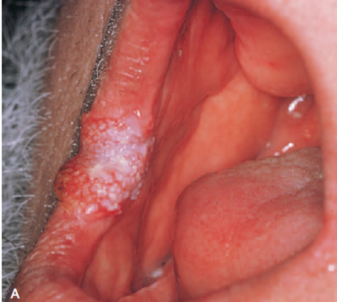 <p>-commissure and anterior buccal mucosa</p><p>-is a specific type of squamous cell carcinoma that is separated from other squamous cell carcinoma because it has a much better prognosis</p><p>-appears as a slow growing exophytic tumor with a pebbly white and red surface</p><p>-most cases occurs in men older than 55 years of age and involves the vestibule and buccal mucosa</p>