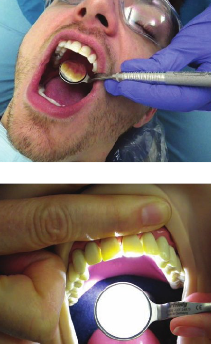 <ul><li><p><strong>Light:</strong> Over oral cavity (perpendicular) to anterior teeth — Patient chin down position (over mouth area) </p></li><li><p><strong>Position</strong>: 12 o’clock </p><ul><li><p>Hold mirror behind central incisors so reflection is parallel to lingual surface</p></li></ul></li><li><p><strong>View: </strong>Anterior teeth will appear to glow</p><ul><li><p>Look directly at the teeth. NOT the mirror’s reflecting surface </p></li></ul></li></ul><p></p>
