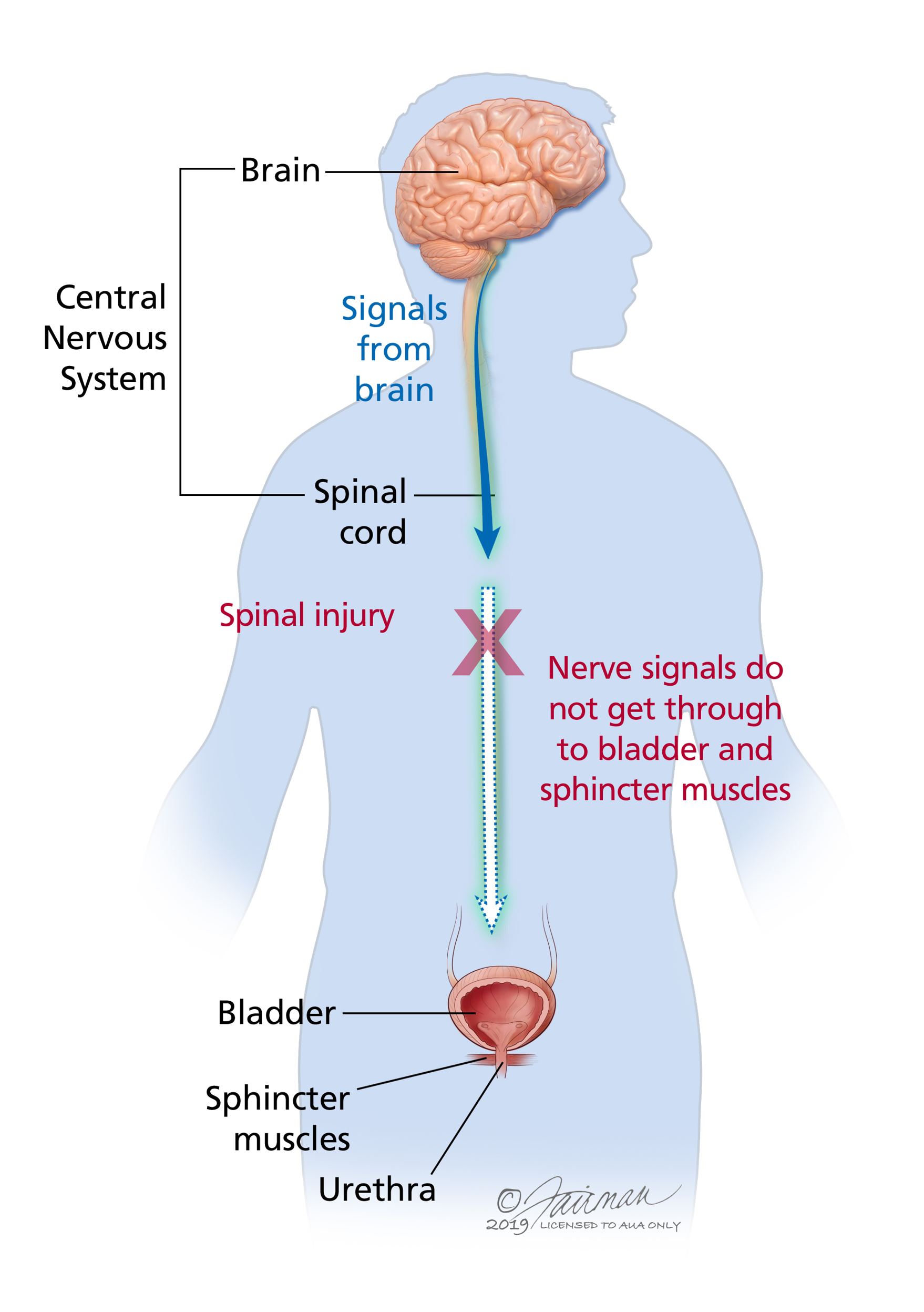 <ul><li><p>lower motor neuron lesion</p></li><li><p>No reflex from S2,3, 4</p></li><li><p>Automatic emptying of bladder</p></li><li><p>Urine fills the bladder and dribbles out</p></li><li><p>Need Foley or frequent intermittent self-catheterization</p></li></ul><p></p>