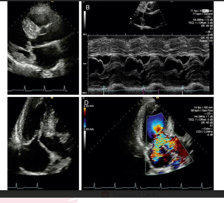 <p>SAM pulls the mitral valve apparatus toward the LVOT, which creates obstruction and can also cause MR.</p>