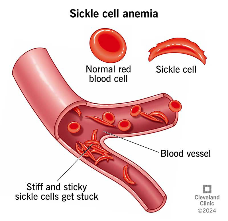 <p>what is an example of a gene mutation?</p>