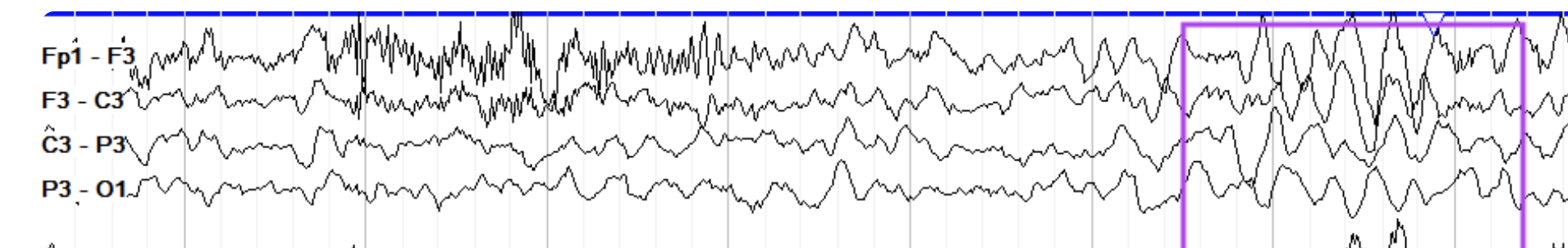 <p>Diffuse slowing</p>