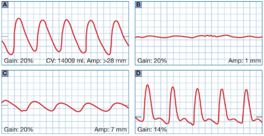 <p>Figure 4–62 shows PVR waveforms with various categories of disease. Identify the category of disease by matching them to the correct corresponding letters of each waveform</p><p>______ Normal</p><p class="p1">______ Mild</p><p class="p1">______ Moderate</p><p class="p1">______ Severe</p>