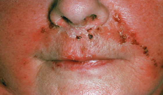 <ul><li><p>S. pyogenes infects the dermal layer of the skin </p></li><li><p>Causes local tissue destruction and sepsis</p></li></ul><p></p>