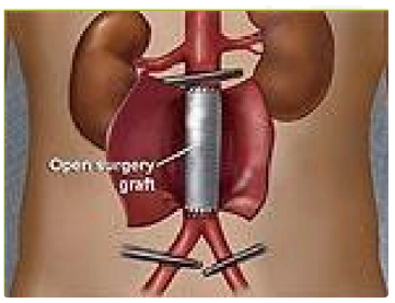 <ul><li><p>vascular pathology is resected</p><ul><li><p>flap remains- open + replace vessel</p></li></ul></li><li><p>end to end anastomosis</p></li><li><p>eg aneurysm</p></li></ul><p></p>