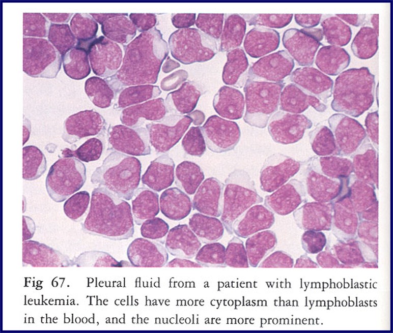 <p>indicates malignancy &amp; hematologic</p>
