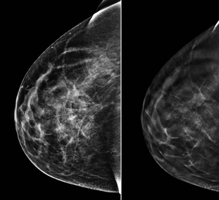 <ul><li><p>glandular and fatty tissues </p></li></ul><ul><li><p>skin line of breast</p></li></ul><p></p>