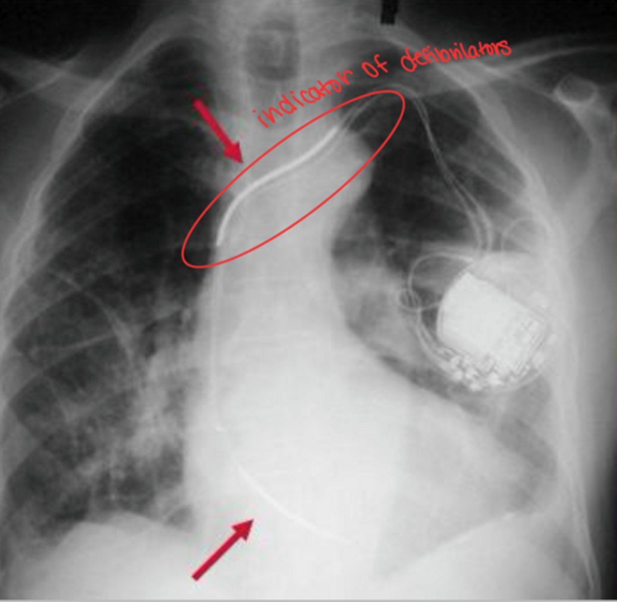 <p>most defibrillators only have one electrode</p><p>1) one electrode in SVC or brachiocephalic vein</p><p>2) if second is used, apex of RV</p>