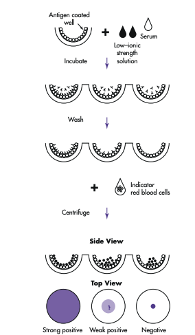 <ul><li><p><strong>Step 1:</strong> Antigen is stuck to the well.</p></li><li><p><strong>Step 2:</strong><span style="color: yellow;"> Patient antibody is added</span><span>. It will wash away if not matched, binds</span> to antigen if compatible.</p></li><li><p><strong>Step 3:</strong> Add indicator RBCs. It will bind to the antibody (if present) already on the well.</p><ul><li><p>If antibodies were present → <strong>indicator RBCs stick to the well</strong> → forms a layer of cells <strong>all over the bottom</strong>.</p></li><li><p>If no antibodies were present → <strong>indicator RBCs do not stick</strong> → they <strong>form a tight button at the bottom when the plate is tilted</strong>.</p></li></ul></li></ul><p></p>