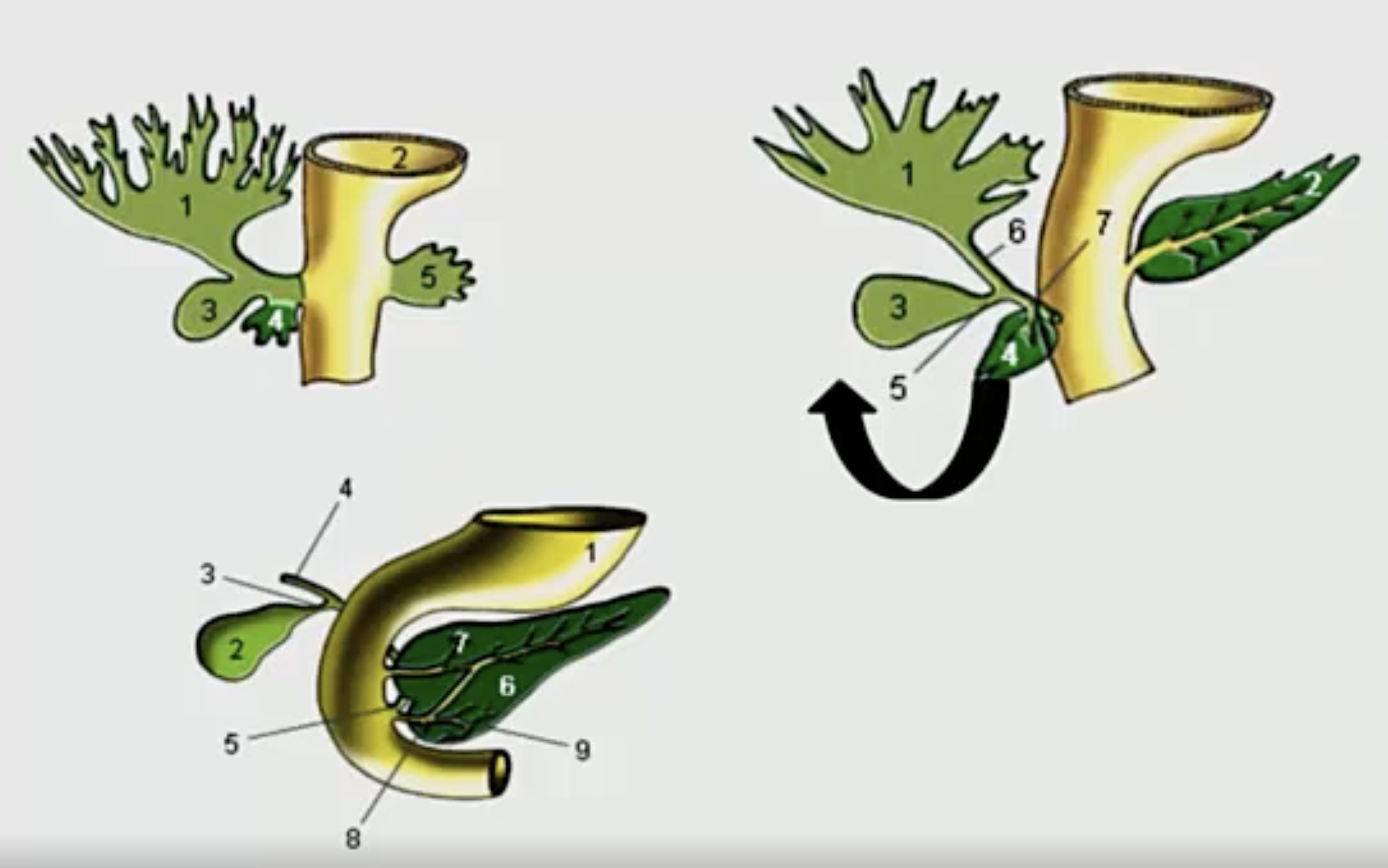 <p>1 = liver</p><p>2 = stomach</p><p>4 = ventral pancreatic bud</p><p>6 = dorsal pancreatic bud</p><p></p><p>As the stomach rotates, the ventral pancreatic bud needs rotate excessively to meet the dorsal pancreatic bud. </p>