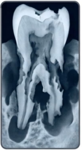 <p>Related to necrotic pulp and inflamed PDL. Extremely rapid destruction. Requires immediate endodontic filling with resorbable paste.</p>