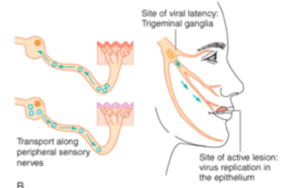 <p>Alvorlig infektion i CNS, især associeret med <strong>HSV-1</strong>.<br>Skaden skyldes både viral cytopatisk effekt og <strong>immunmedieret inflammation</strong>.</p>