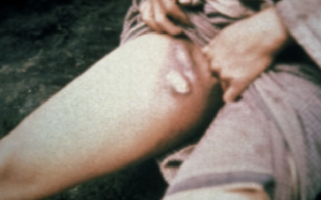 <p>⚠️‼️(#18,#20,#27,#31)19.The lesion can be found in infections caused by _____. Choose the best answer. A.Both H. ducreyi and LGV B.H. ducreyi C.Lymphogranuloma venereum D.Calymmatobacterium granulomatis</p>