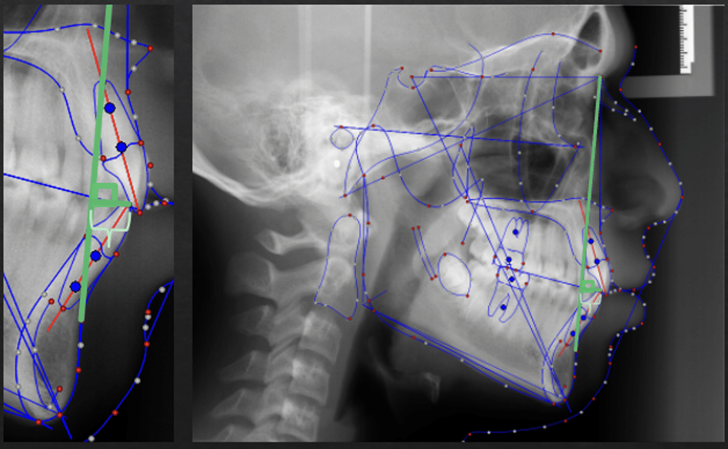 <p>what distance measurement:</p><p>- Nasion-B Point to the lower incisors</p><p>- AP relationship between the cranial base, mandible, and the lower incisors</p><p>- Measured from the incisal edge of the lower incisor to Nasion-B Point along a perpendicular line</p><p>- If L1 is anterior to NB, the measurement is positive</p><p>- If L1 is posterior to NB, the measurement is negative</p><p>- Tells you about the horizontal position of the lower incisors</p>