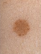 <p><span>Flat, circumscribed area of color change <1 cm (e.g., freckle).</span></p>