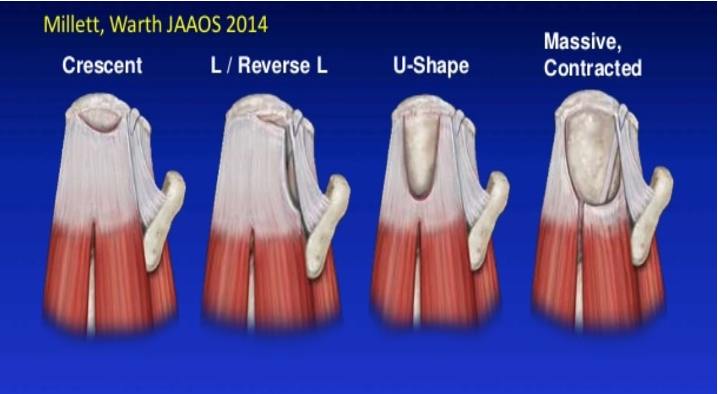 <p>U shape tear with longitudinal split anteriorly</p>