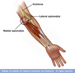 <p>medial epicondylitis = golfers elbow </p><p>if this was tennis elbow itd be .....lateral epicondylitis!</p>