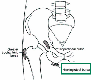 <p><span style="color: red;"><strong>Ischiogluteal Bursitis “Weaver’s Bottom”</strong></span></p>