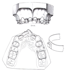 <p>what orthodontic appliance:</p><p>◦ Developed in 1910 by Edward Angle</p><p>◦ Bands on all teeth</p><p>◦ Vertical slot hook that holds horizontal wire</p><p>◦ Wire is made of a gold platinum alloy</p><p>◦ No more soldered pins</p>