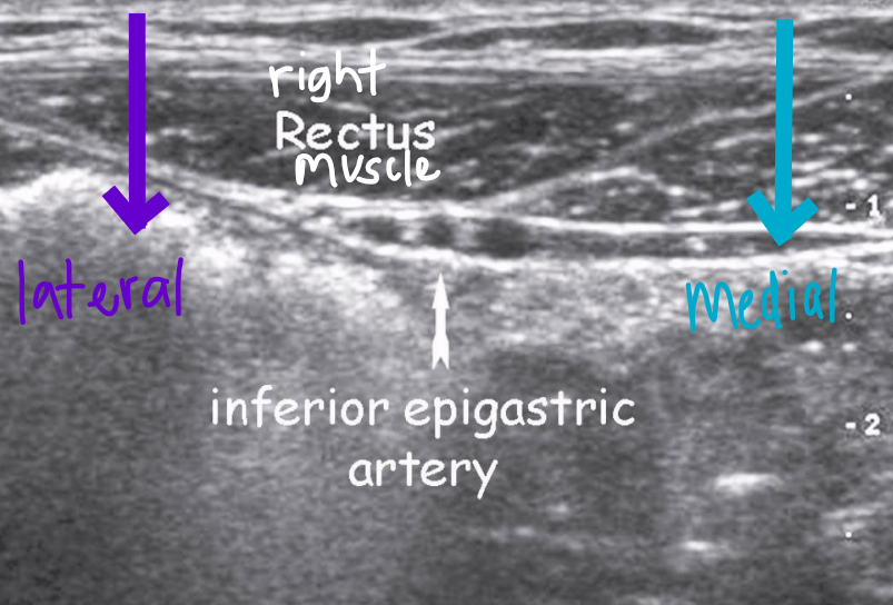 <ul><li><p>Most common location for a hernia (~75% of all hernias)</p></li><li><p>Location: near internal inguinal ring, surrounding inferior epigastric vessels (IEV)</p><ul><li><p>Medial to IEV: direct inguinal hernia</p></li><li><p>Lateral to IEV: indirect inguinal hernia</p></li></ul></li></ul><p></p>