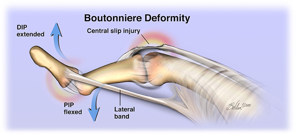 <p><span style="color: green;"><strong>Zone III/3</strong></span> Extensor Injury<strong> “Boutonniere” </strong></p>