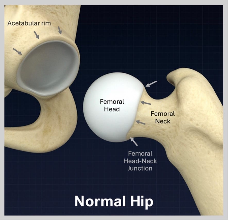 <p>Reference for cup seating and osteophyte removal.</p>