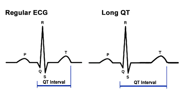 <p>long QT syndrome</p>