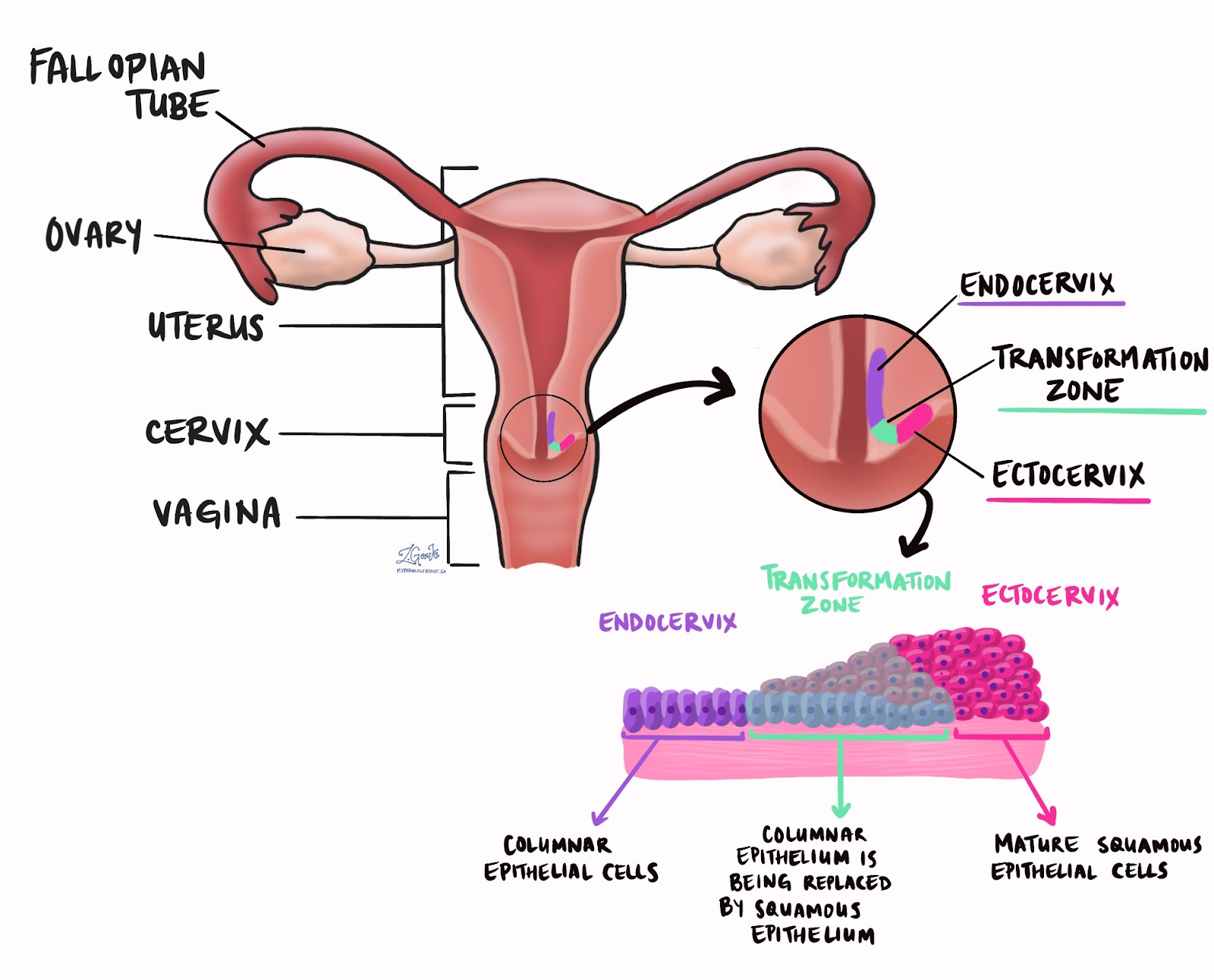<p>Endocervical Mucosa: Simple columnar epithelium</p><ul><li><p>Inside canal</p></li></ul><p>Exocervical Mucosa: Stratified squamous epithelium</p><ul><li><p>Around external os → Upper vagina (continuous)</p></li></ul><p>Transformation Zone: Squamous-columnar epithelium</p><ul><li><p>Transition between endo and exocervical mucosa</p><ul><li><p>Around external os</p></li></ul></li><li><p>Vaginal environment exposure = Reprogram epithelial stem cells = Neoplasia</p></li></ul><p></p>