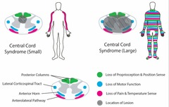<p>Motor impairment greater in upper limbs.</p>