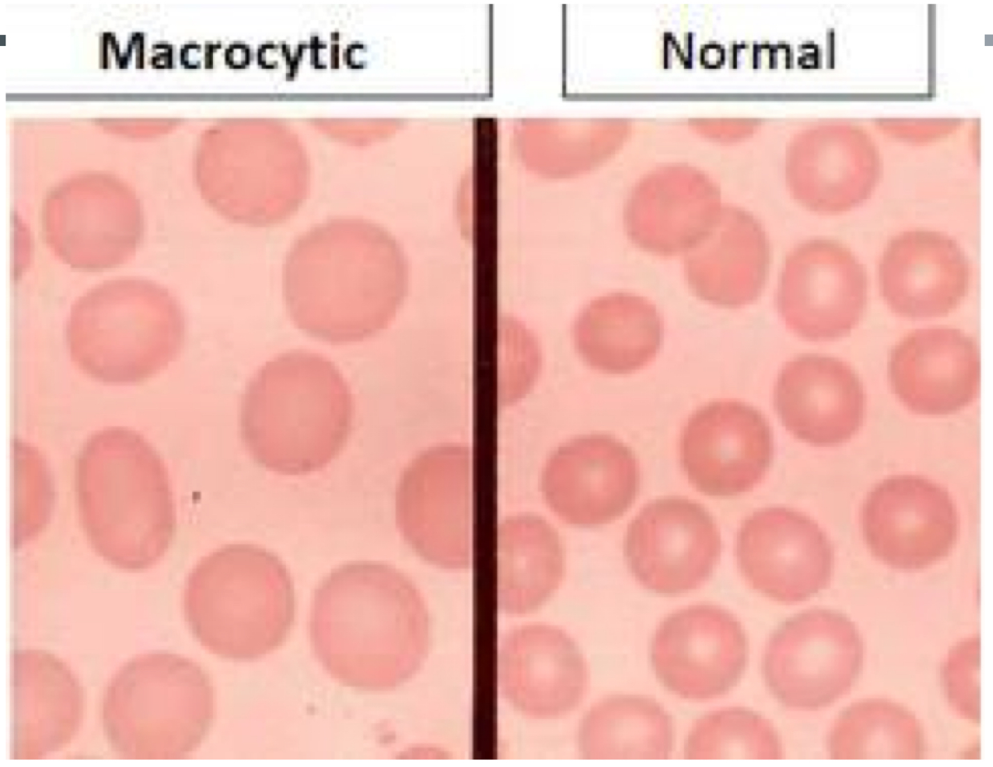 <ul><li><p>>96</p></li><li><p>EtOH use disorder - normal RDW</p></li><li><p>folate deficiency - normal RDW</p></li><li><p>HYPOthyroidism</p></li><li><p>chronic liver disease (elevated RDW)</p></li><li><p>medications: methotrexate, imuran, hydroxyurea - normal RDW</p></li><li><p>multiple myeloma- elevated RDW</p></li><li><p>myelodysplastic syndrome- elevated RDW</p></li><li><p>pernicious anemia</p></li><li><p>B12 def- elevated RDW<br></p></li></ul><p></p>