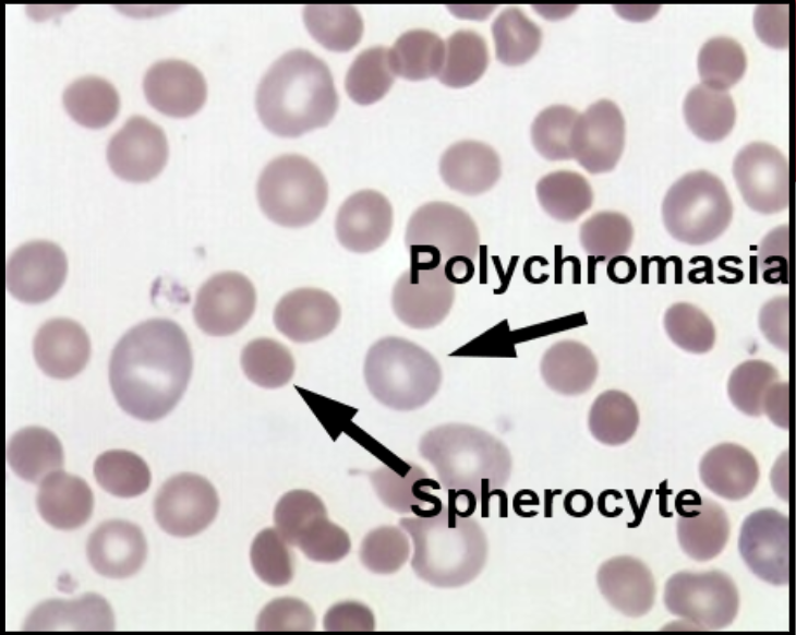 <p><strong>Smear Findings</strong>: few to many spherocytes</p><p><strong>MCV</strong>: 82 - 98</p>