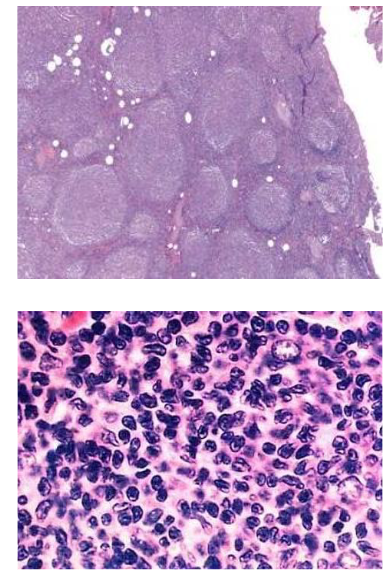 <p>- Follicular pattern</p><p>- Predominantly small cells</p><p>- t(14;18)(q32,q21);IGH/BCL2</p><p>.</p><p>Up-regulates expression of anti- apoptotic protein Bcl-2</p><p>- Survival advantage of B cells</p><p>- Anti-apoptotic: inhibits programmed cell death</p>