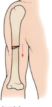 <p>A fracture where one bone fragment is driven into another, often due to compressive forces. </p>