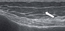 <p><span style="background-color: transparent;">Heterogeneous with hypoechoic fat lobules</span></p>