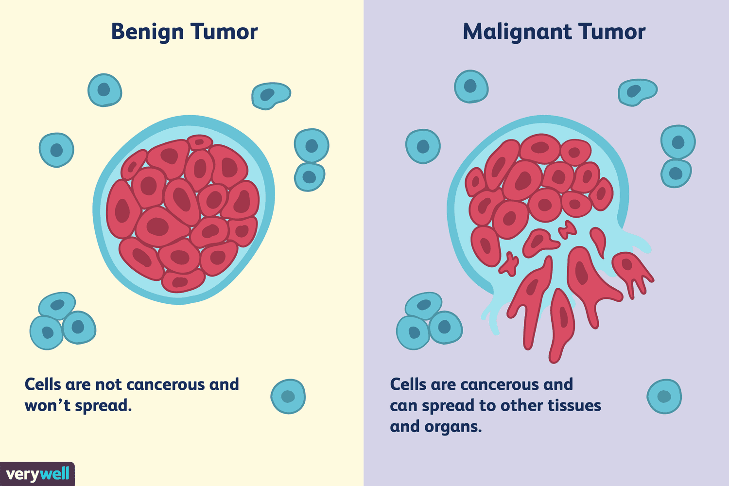 <p>- also called benign tumors,</p><p>- are overgrowths of cells and tissue that are not expected.</p>
