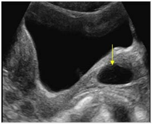 <p>What pathology are we seeing in this image?</p>