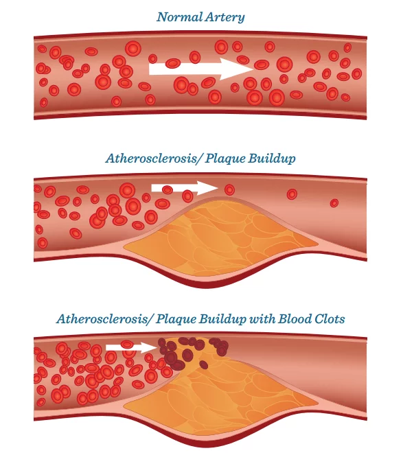 <ul><li><p>plaque accumulates in artery walls</p></li><li><p>plaque hardens and narrows arteries reducing oxygen rich blood flow to body</p></li><li><p>type of arteriosclerosis</p></li></ul><p></p>