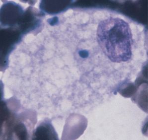 <p>What is the classification, characterization, and morphology of Niemann-pick disease?</p>