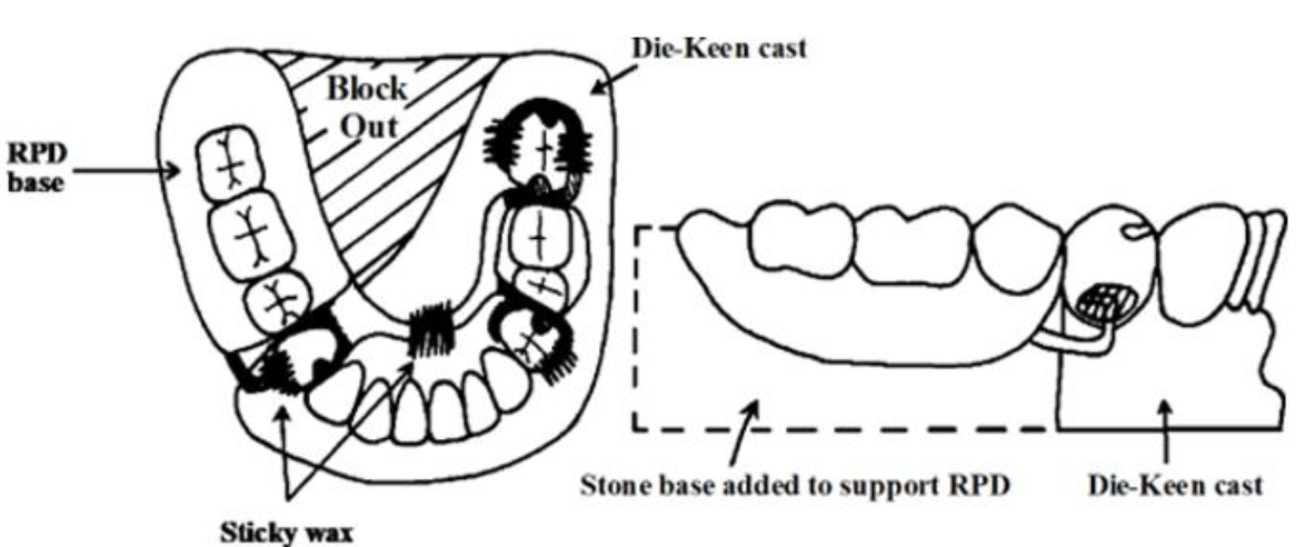 <p>Why would you remove the free-end/distal extension area in a remount cast</p>