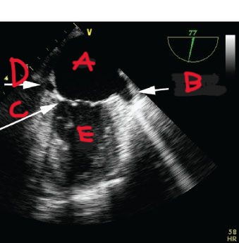 <p>What is at A?</p>