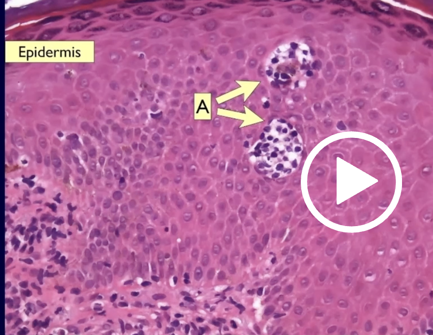 <p>Tricoleucemia </p><p>Microabscesos de Munro—> psoriasis </p>