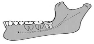 <p><span style="color: red;">easiest</span> to remove</p><p>has a sufficient space for eruption</p><p>lower third molar is positioned <span style="color: red;">anterior to the ramus</span></p>
