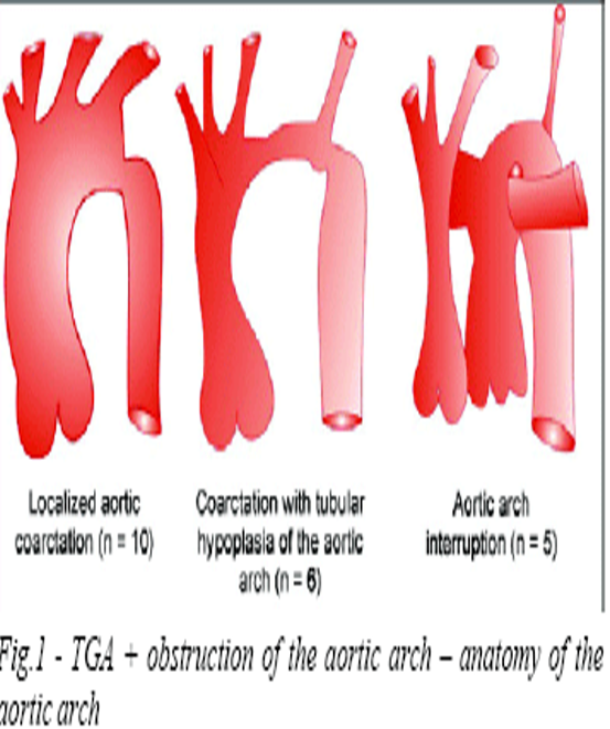 <p>tubular narrowing of entire ao arch segment</p><p>typically affects ao isthmus </p>