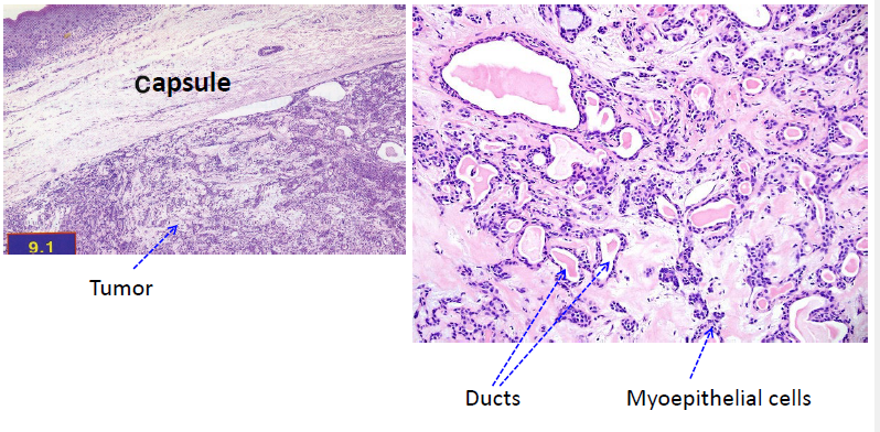 <ul><li><p>mixture of ductal and myoepithelial elements</p></li><li><p>well-circumscribed, encapsulated</p></li><li><p>ducts and cystic structures</p></li><li><p>myoepithelial cells </p></li><li><p>stromal changes: myxoid, hyalinized, focal areas of fat, chondroid, and osteoid </p></li></ul><p></p>