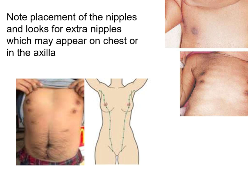 <ul><li><p>note placement of nipples and look for extra nipples which may appear on chest or in the axilla </p></li></ul><p></p>
